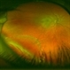 Asymptomatic Rhegmatogenous Retinal Detachment Asymptomatic Rhegmatogenous Retinal Detachment